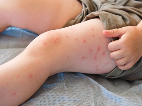 crianca-morre-por-complicacao-rara-do-sarampo-anos-apos-ser-infectada