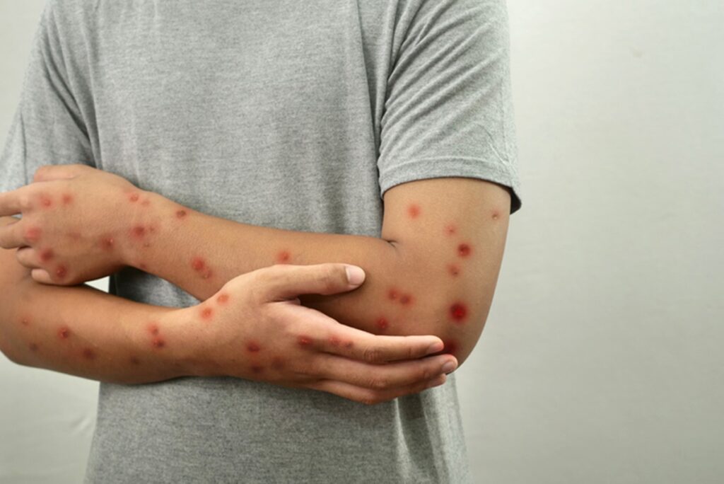 “a-mpox-nao-acabou-e-ainda-exige-vigilancia-constante”,-diz-medica