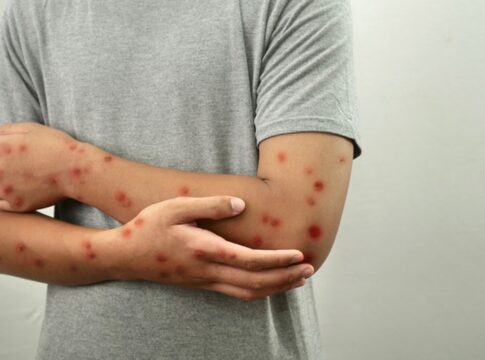 “a-mpox-nao-acabou-e-ainda-exige-vigilancia-constante”,-diz-medica