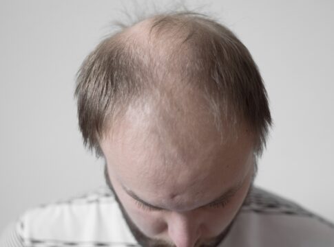 careca-doce:-composto-de-estevia-faz-crescer-67%-mais-cabelo-em-calvos