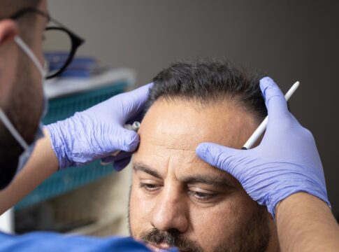 transplante-capilar:-confira-5-perguntas-para-entender-o-procedimento