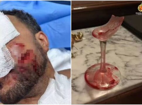 veja-como-ficou-o-rosto-de-funcionario-agredido-com-taca-por-advogado
