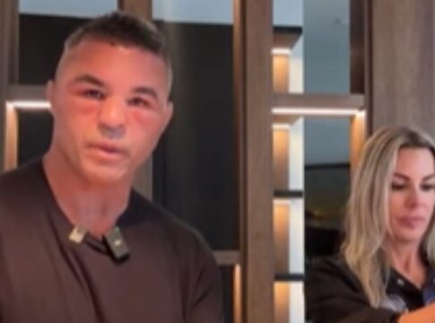 vitor-belfort-deixa-web-chocada-apos-realizar-implante-capilar;-veja