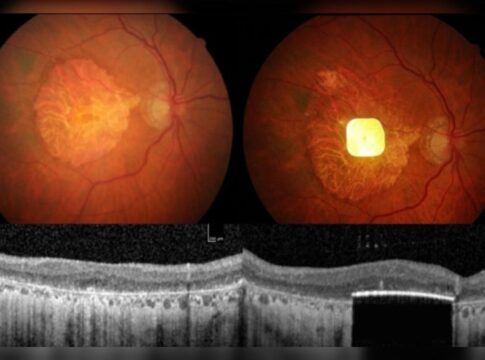 implante-de-retina-devolve-parte-da-visao-a-pessoas-com-cegueira