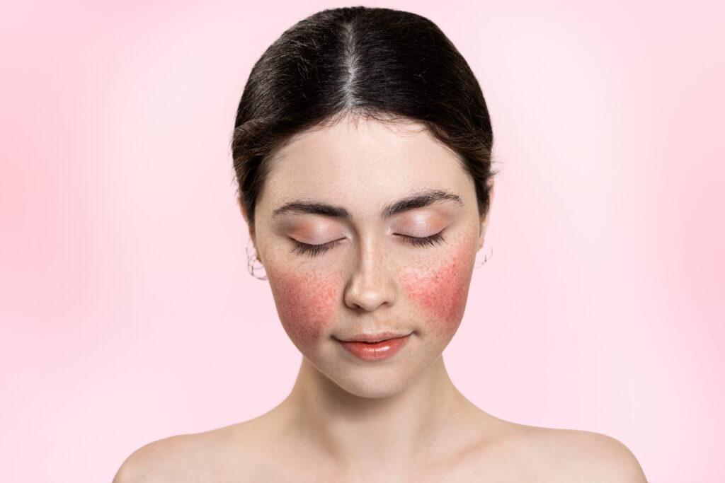 rosacea-e-o-novo-blush?-trend-transforma-imperfeicoes-em-inspiracao
