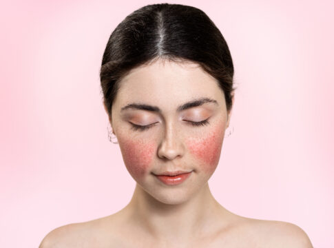 rosacea-e-o-novo-blush?-trend-transforma-imperfeicoes-em-inspiracao