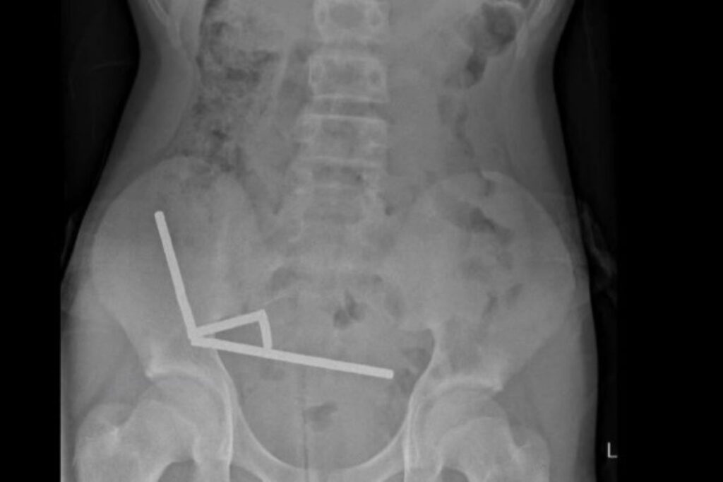 adolescente-engole-mais-de-80-imas-e-perde-parte-do-intestino