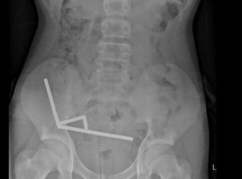 adolescente-engole-mais-de-80-imas-e-perde-parte-do-intestino