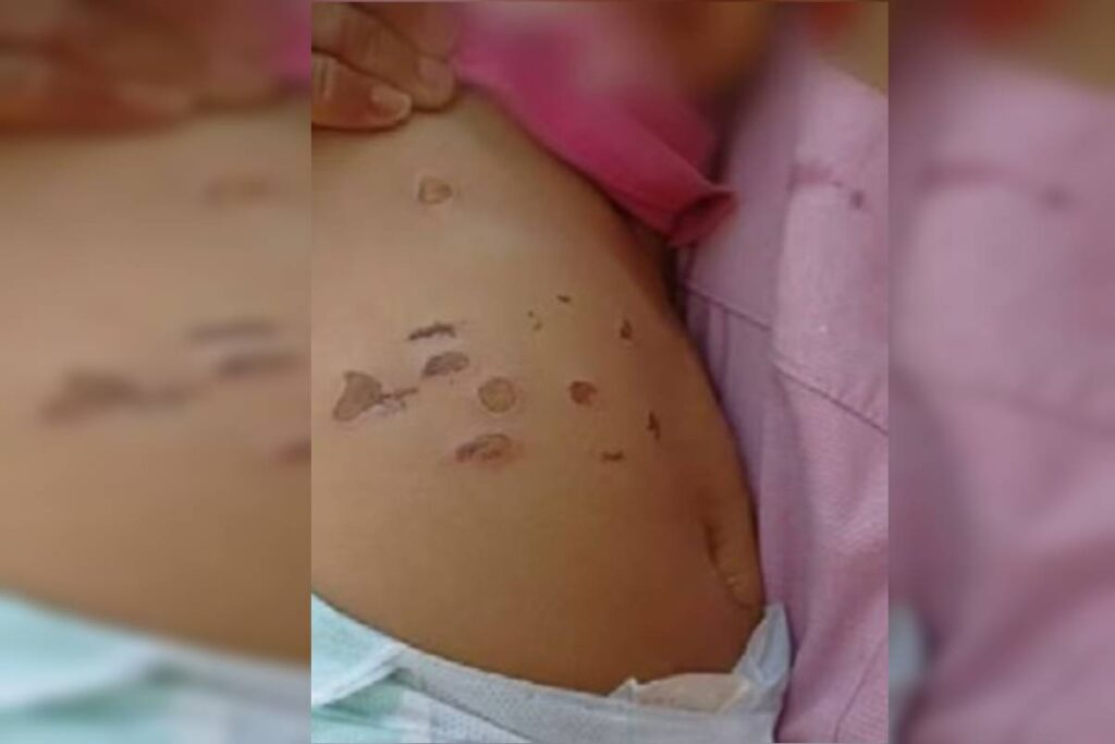 menina-de-10-meses-foi-queimada-por-cigarros-na-barriga-e-nas-pernas