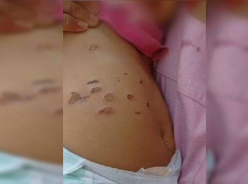 menina-de-10-meses-foi-queimada-por-cigarros-na-barriga-e-nas-pernas