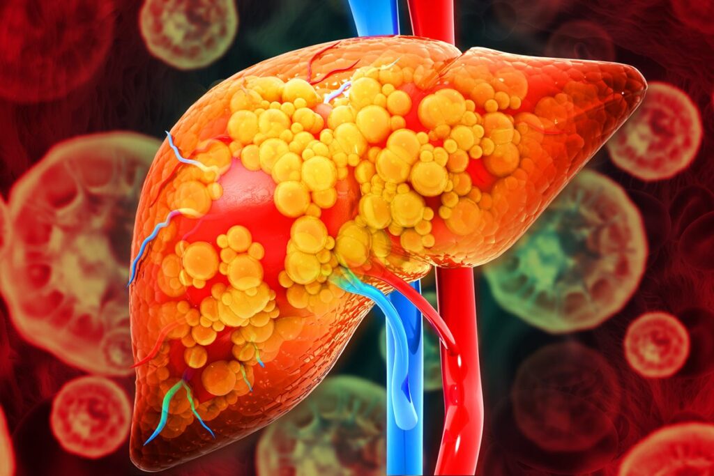 gordura-no-figado:-hepatologista-aponta-bebidas-perigosas-para-o-orgao