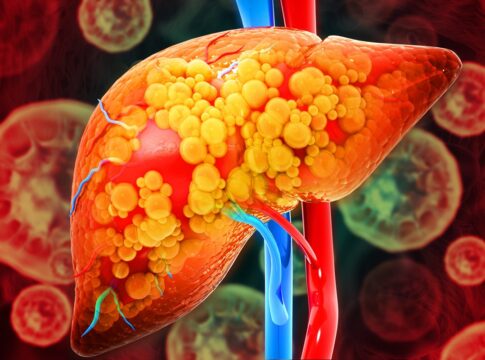 gordura-no-figado:-dicas-simples-para-evitar-a-esteatose-hepatica