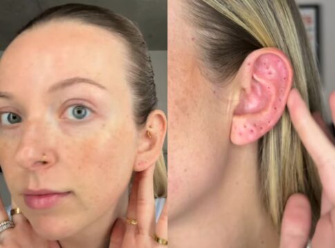 mulher-retira-41-piercings-e-e-criticada-apos-exibir-furos-na-orelha