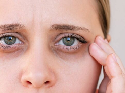 veja-5-truques-naturais-que-podem-ajudar-a-melhorar-as-olheiras