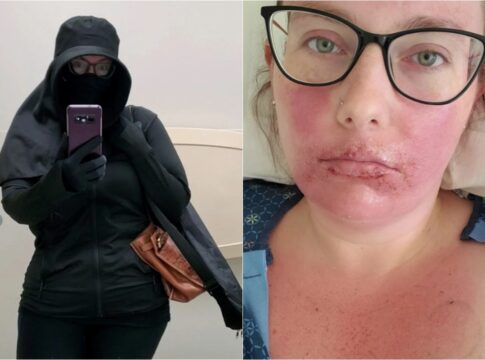 “tenho-que-viver-como-uma-vampira”,-diz-mulher-com-alergia-ao-sol