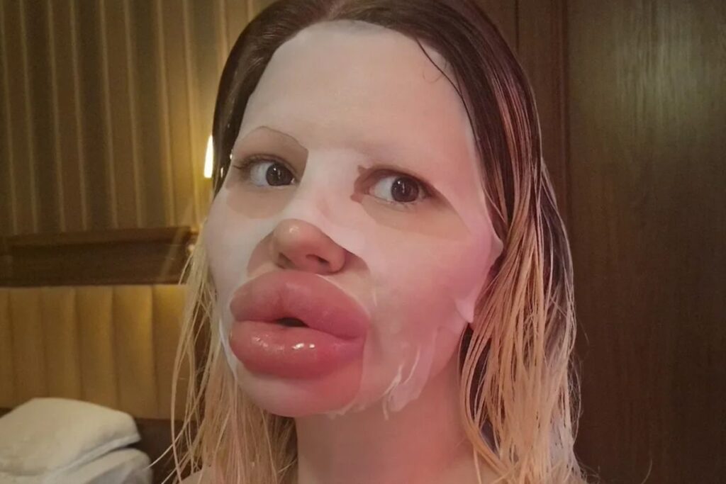 mulher-gasta-mais-de-r$-140-mil-para-ter-os-maiores-labios-do-mundo