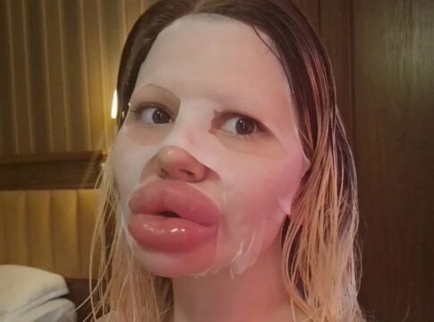 mulher-gasta-mais-de-r$-140-mil-para-ter-os-maiores-labios-do-mundo