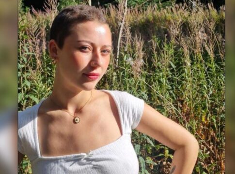 jovem-de-23-anos-perde-todo-o-cabelo-apos-crise-de-estresse-no-trabalho