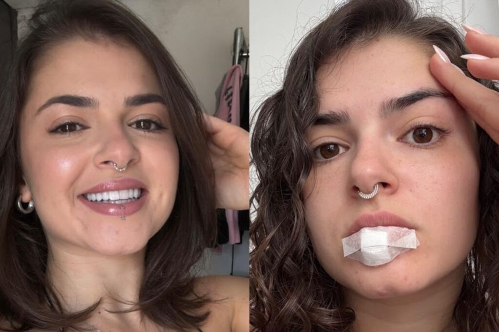 miss-bumbum-relata-acidente-com-piercing-durante-relacao-intima