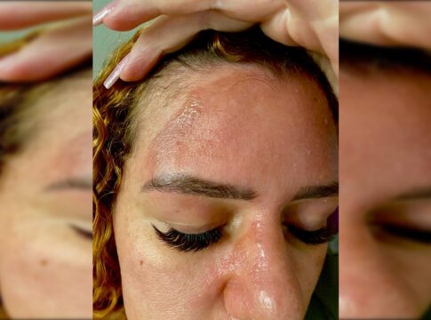 influenciadora-tem-serias-queimaduras-apos-panela-de-pressao-explodir