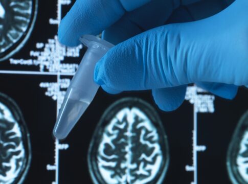 brasileiros-testam-potencial-remedio-de-baixo-custo-contra-alzheimer