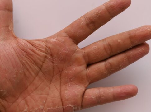 entenda-o-que-bolhas-nos-pes-e-nas-maos-podem-significar