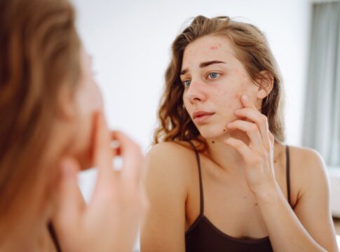 cicatrizes-de-acne:-veja-como-prevenir-e-dicas-para-cuidar