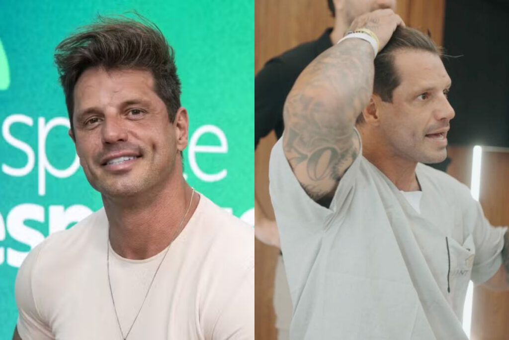 fotos:-fernando-fernandes-passa-por-transplante-capilar