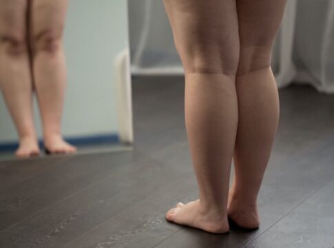 estes-suplementos-e-medicamentos-sao-essenciais-para-quem-tem-lipedema