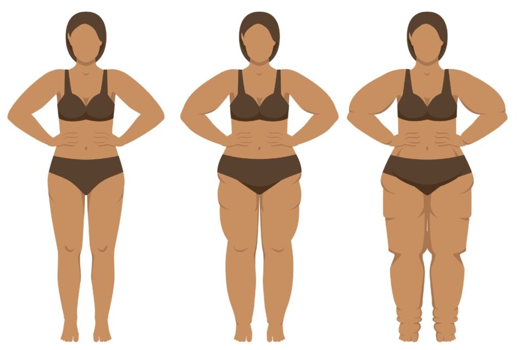 lipedema:-3-ajustes-fundamentais-na-dieta-para-controlar-a-doenca