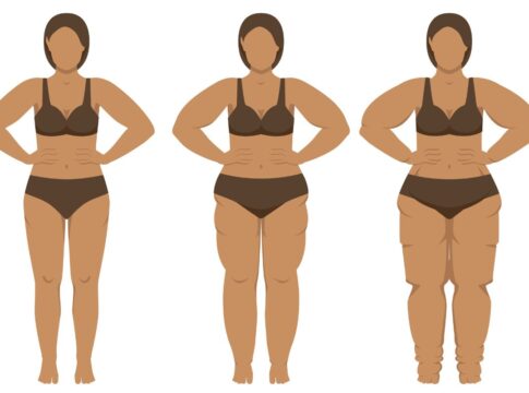 lipedema:-3-ajustes-fundamentais-na-dieta-para-controlar-a-doenca