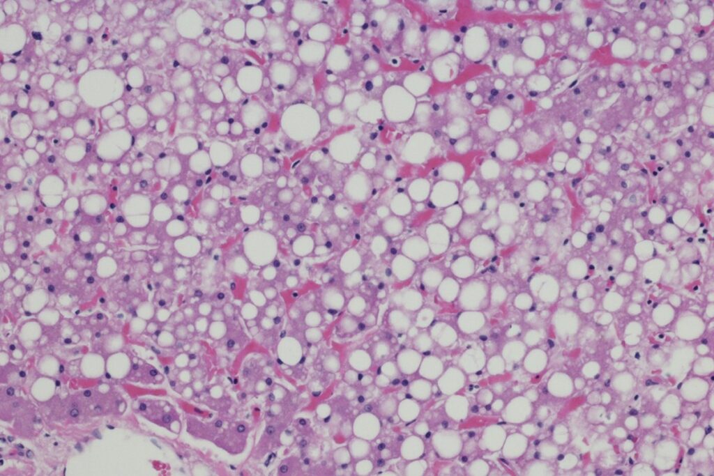 confira-uma-lista-de-habitos-simples-para-tratar-a-gordura-no-figado