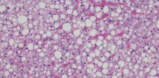 confira-uma-lista-de-habitos-simples-para-tratar-a-gordura-no-figado