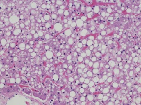 confira-uma-lista-de-habitos-simples-para-tratar-a-gordura-no-figado