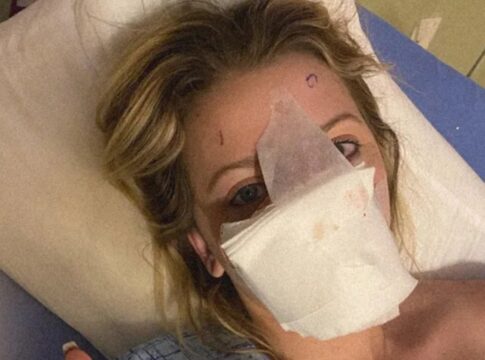 mulher-que-teve-nariz-arrancado-por-cao-mostra-o-rosto-apos-16-cirurgias