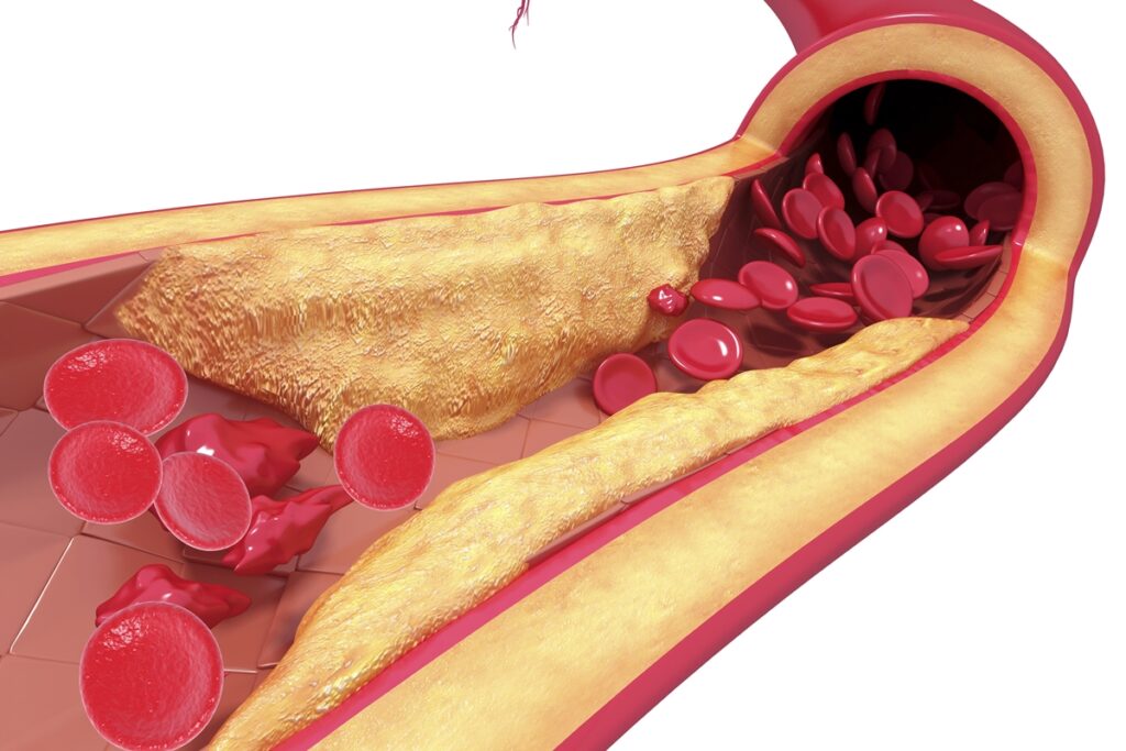 cardiologista-cita-5-habitos-simples-que-ajudam-a-“limpar”-as-arterias