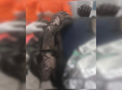 veja-como-trabalhador-queimado-apos-explosao-chegou-a-hospital-no-df