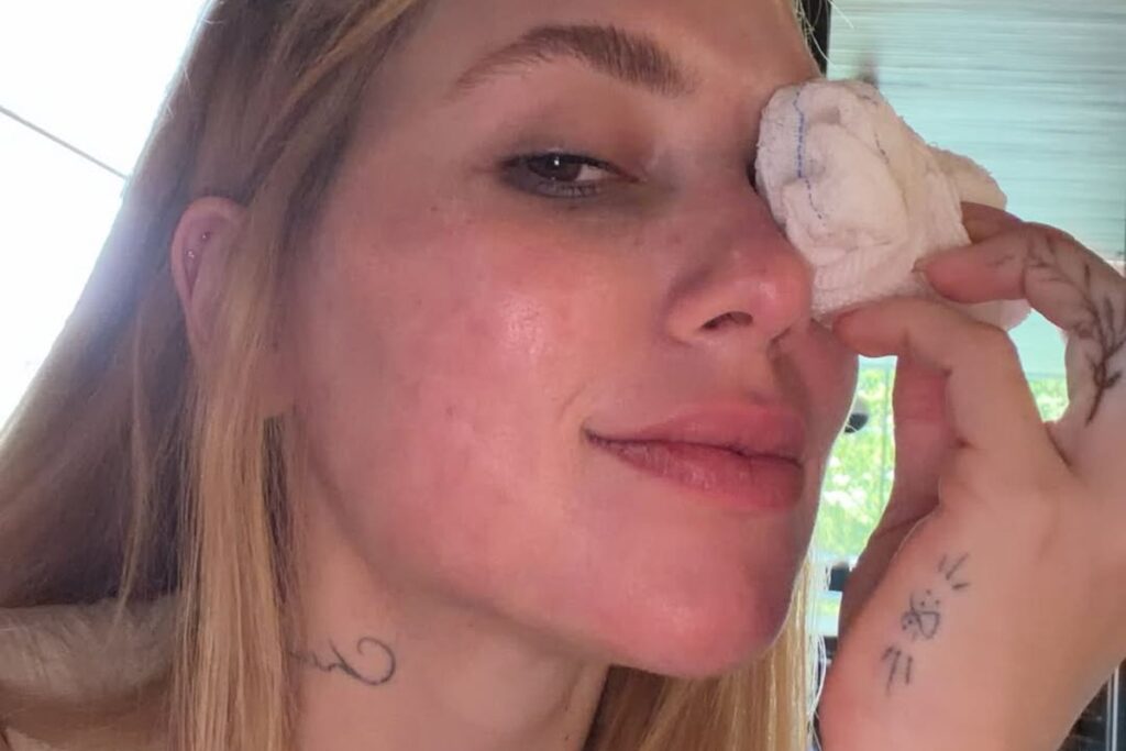 virginia-surge-com-lesao-no-olho-apos-acidente-envolvendo-a-filha