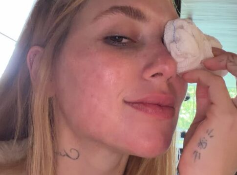 virginia-surge-com-lesao-no-olho-apos-acidente-envolvendo-a-filha