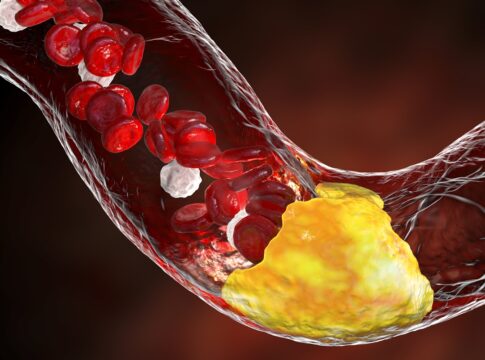 cardiologista-cita-principais-sintomas-de-que-arterias-estao-entupidas