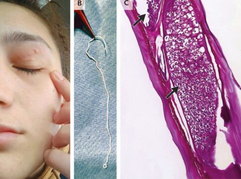 verme-vivo-de-11-cm-e-retirado-da-palpebra-de-mulher-na-romenia