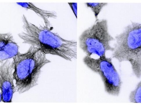 tratamento-potencial-dribla-resistencia-em-cancer-infantil-agressivo