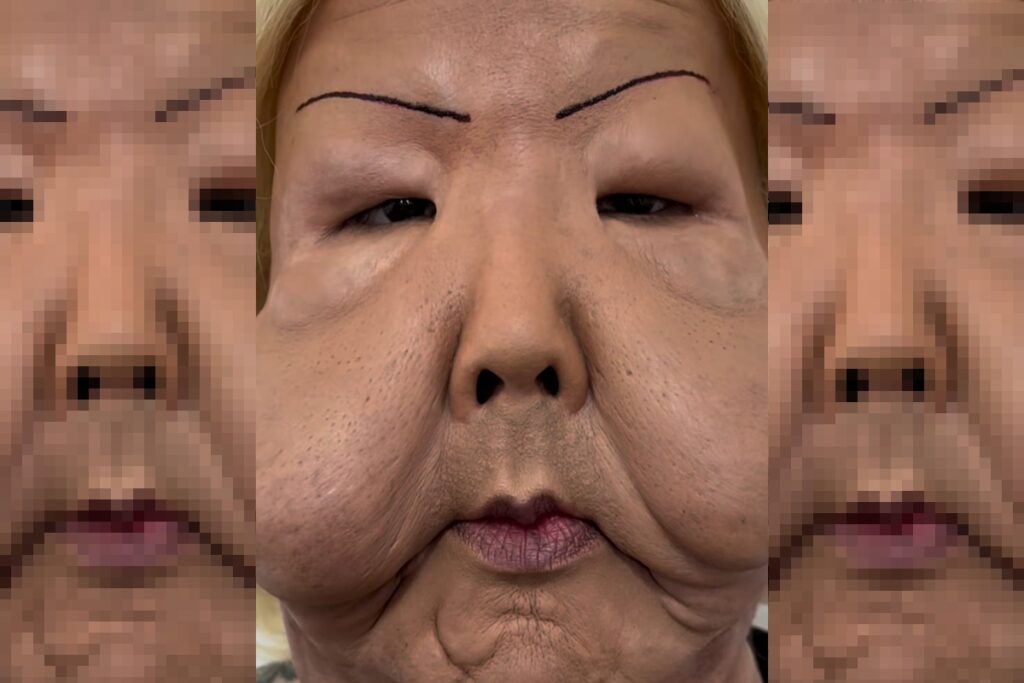 video:-juju-do-pix-mostra-como-ficou-o-rosto-deformado-apos-cirurgia