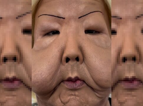 video:-juju-do-pix-mostra-como-ficou-o-rosto-deformado-apos-cirurgia