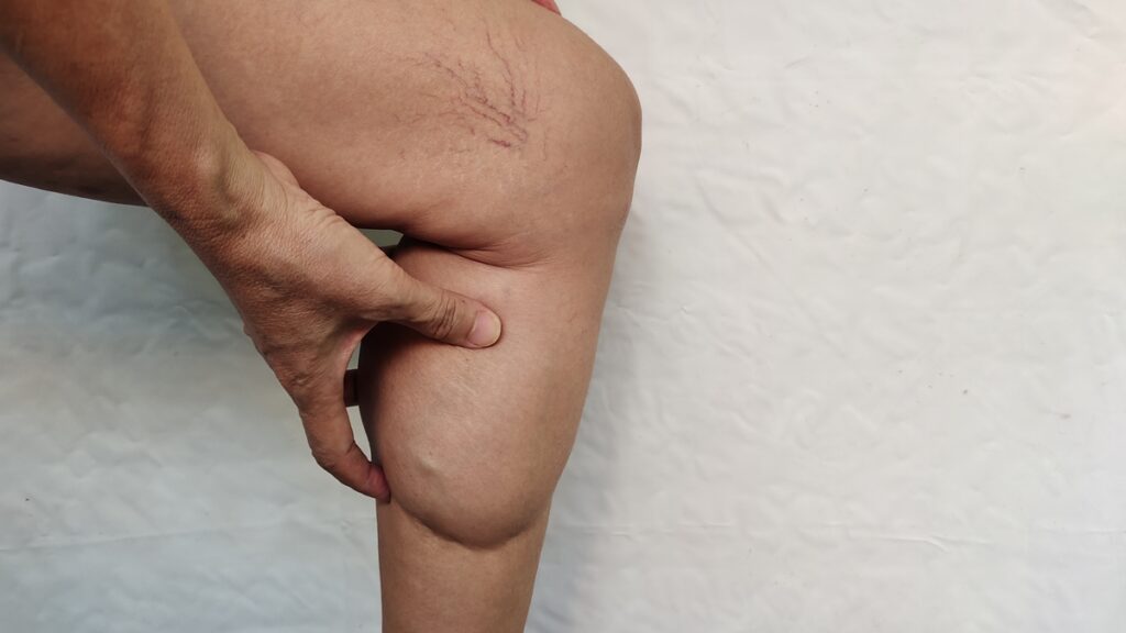 emagrecer-melhora-o-lipedema?-veja-se-a-dieta-atua-contra-a-doenca