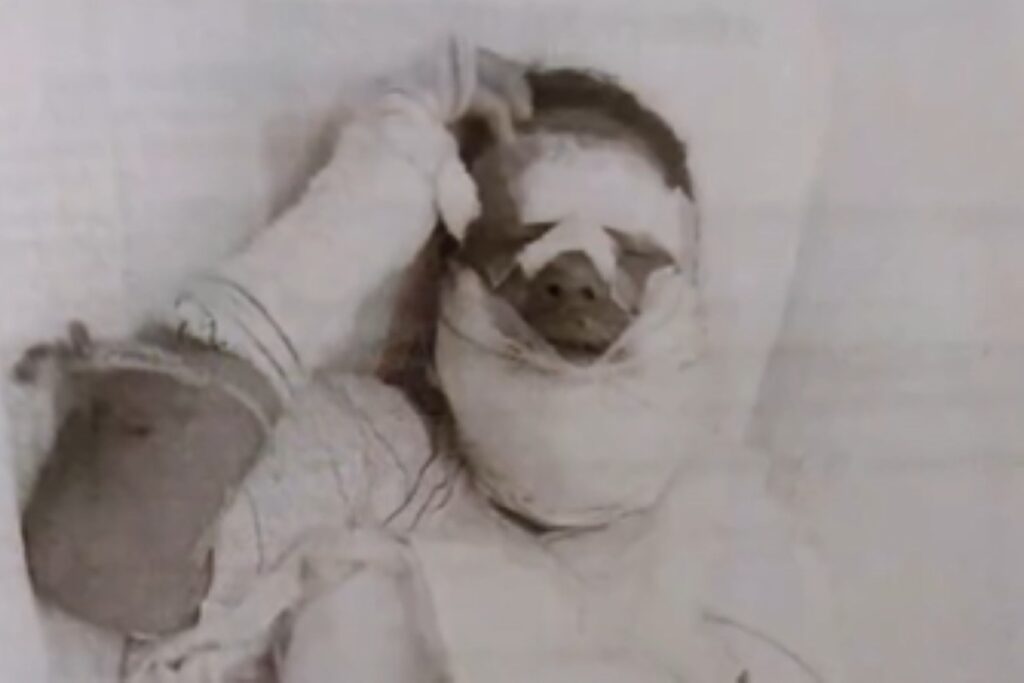 apos-briga,-homem-joga-alcool-e-ateia-fogo-no-rosto-de-companheira