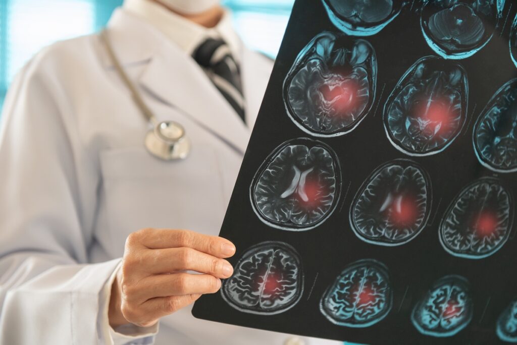 neurologista-alerta-para-sintomas-leves-que-podem-surgir-antes-do-avc