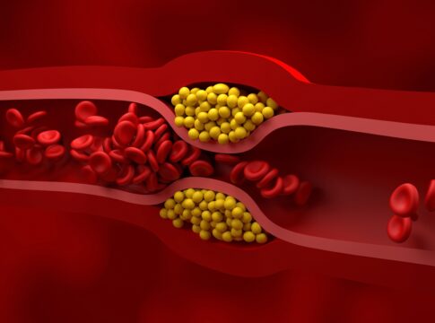 endocrinologista-explica-como-reconhecer-os-sinais-de-colesterol-alto