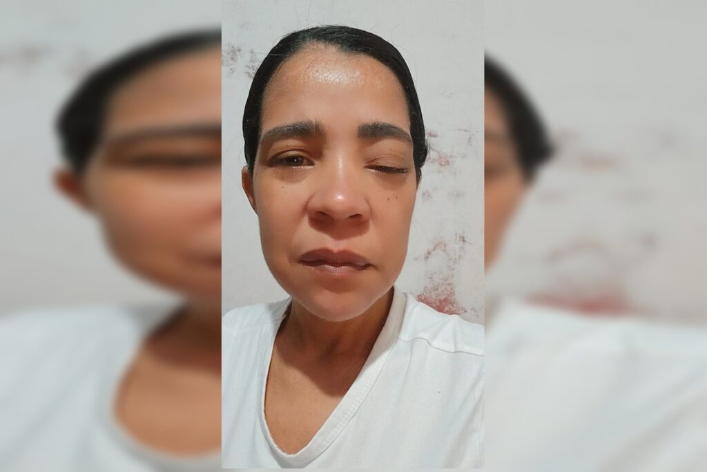 mae-de-66-anos-sofre-ao-ver-filha-sem-remedio-para-cancer-de-pele