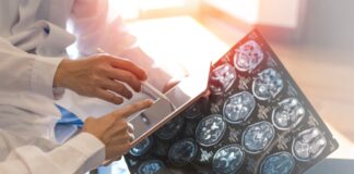 esclerose-multipla:-exame-em-teste-pode-adiantar-diagnostico-em-7-anos